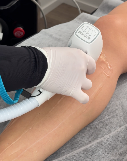 Laserbehandlung am Unterschenkel im Studio von Beauty Artistry Villingen